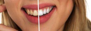 הלבנת שיניים לפני ואחרי