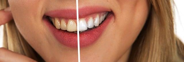 הלבנת שיניים ביתית